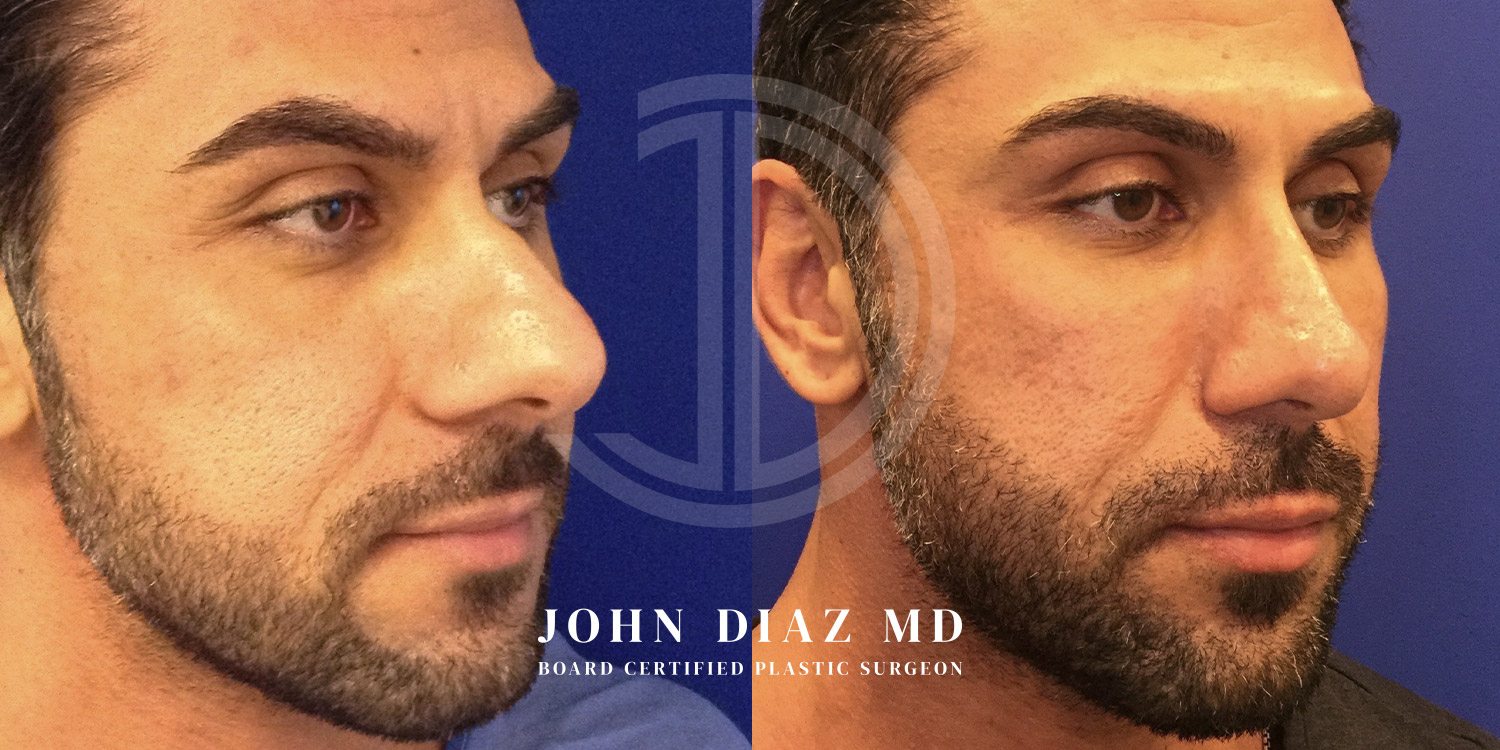 Dr John Diaz Before and After | Rhinoplasty