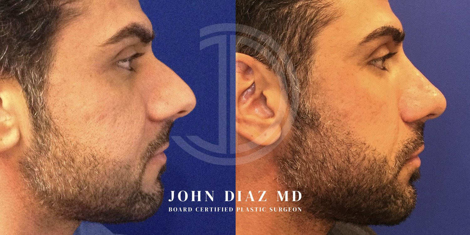 Dr John Diaz Before and After | Rhinoplasty
