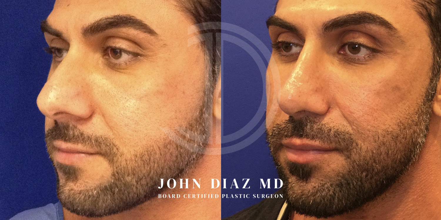 Dr John Diaz Before and After | Rhinoplasty