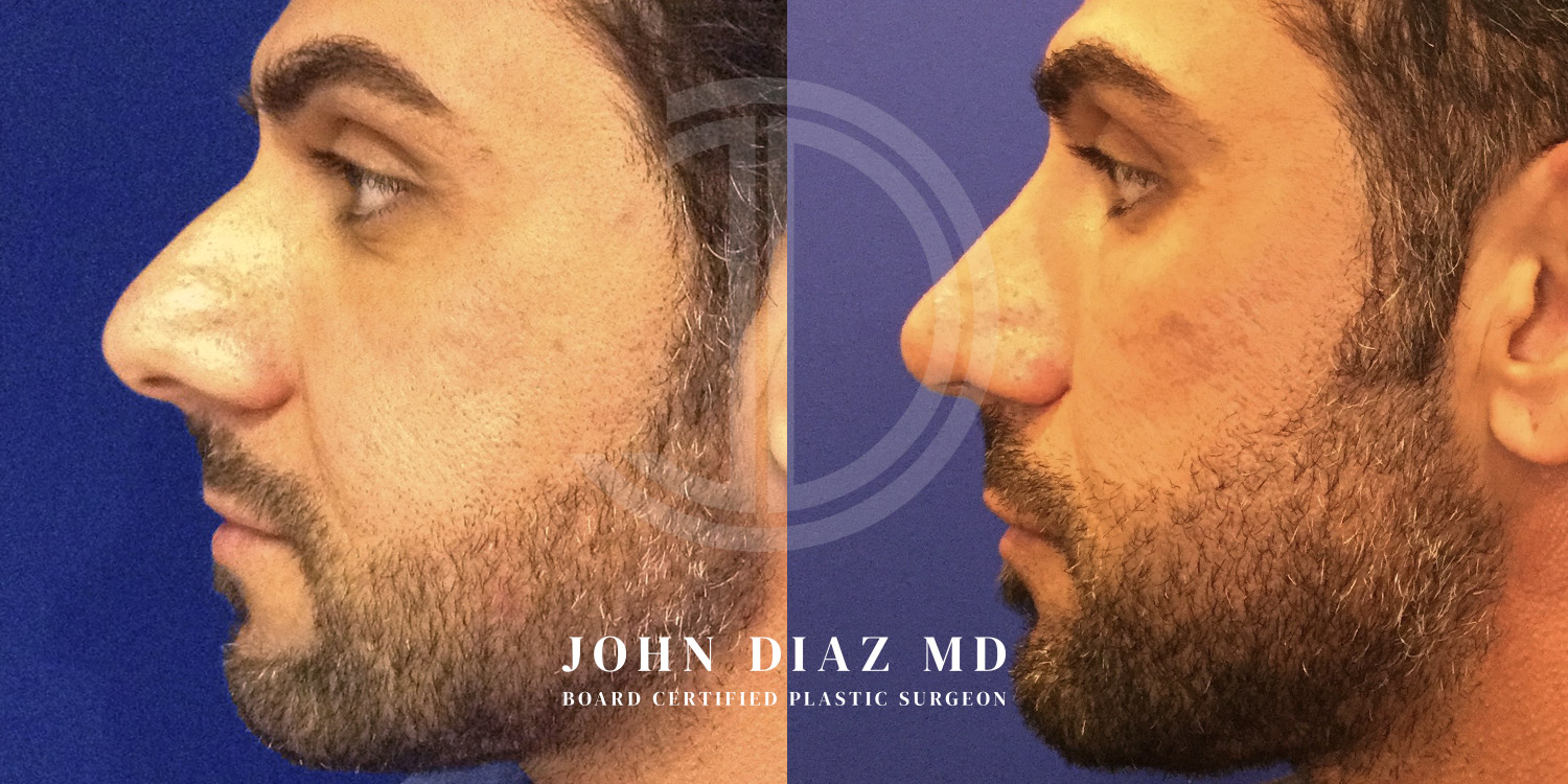 Dr John Diaz Before and After | Rhinoplasty