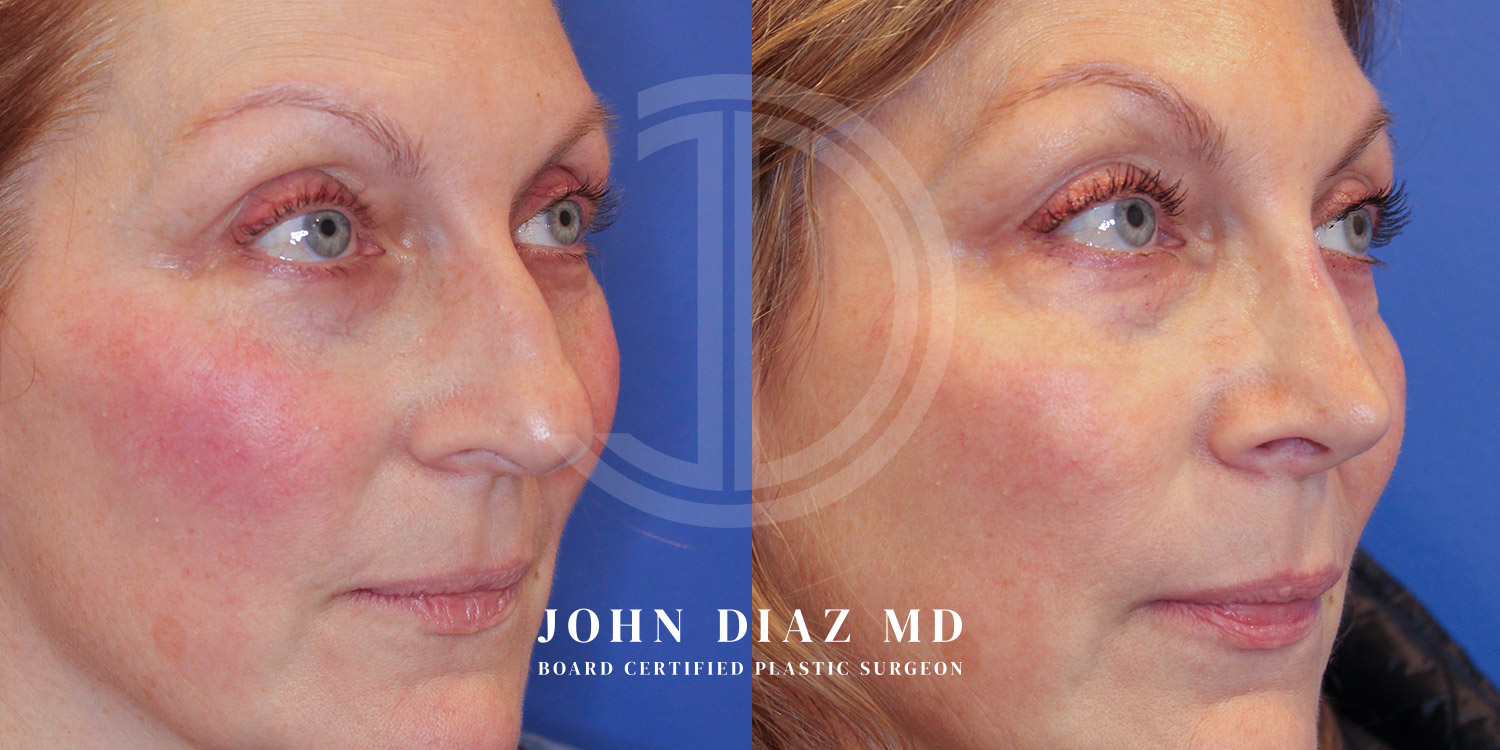 Dr John Diaz Before and After | Rhinoplasty