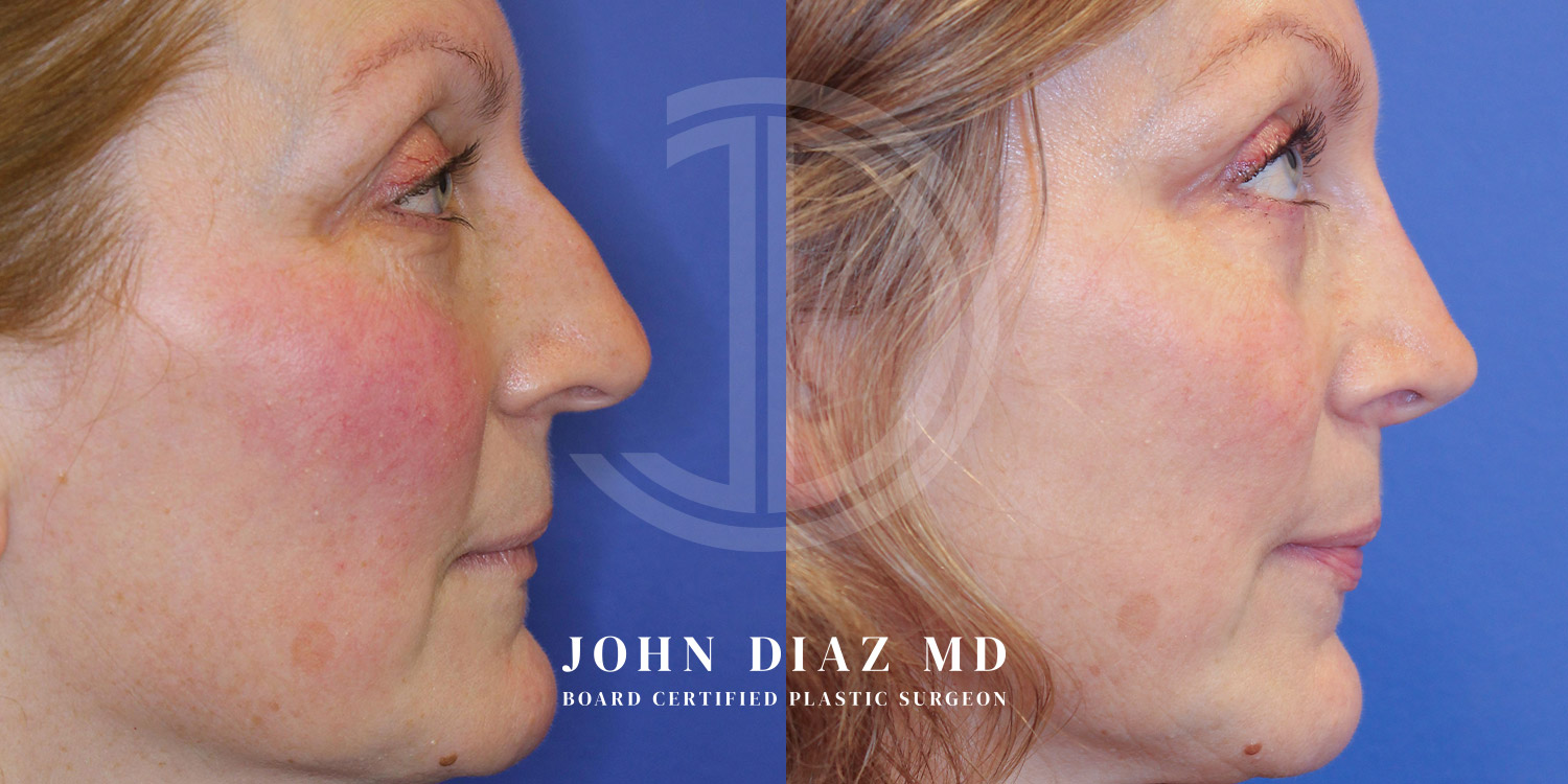 Dr John Diaz Before and After | Rhinoplasty