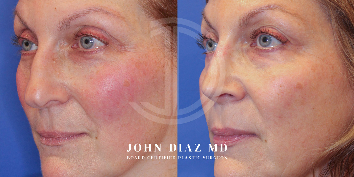 Dr John Diaz Before and After | Rhinoplasty