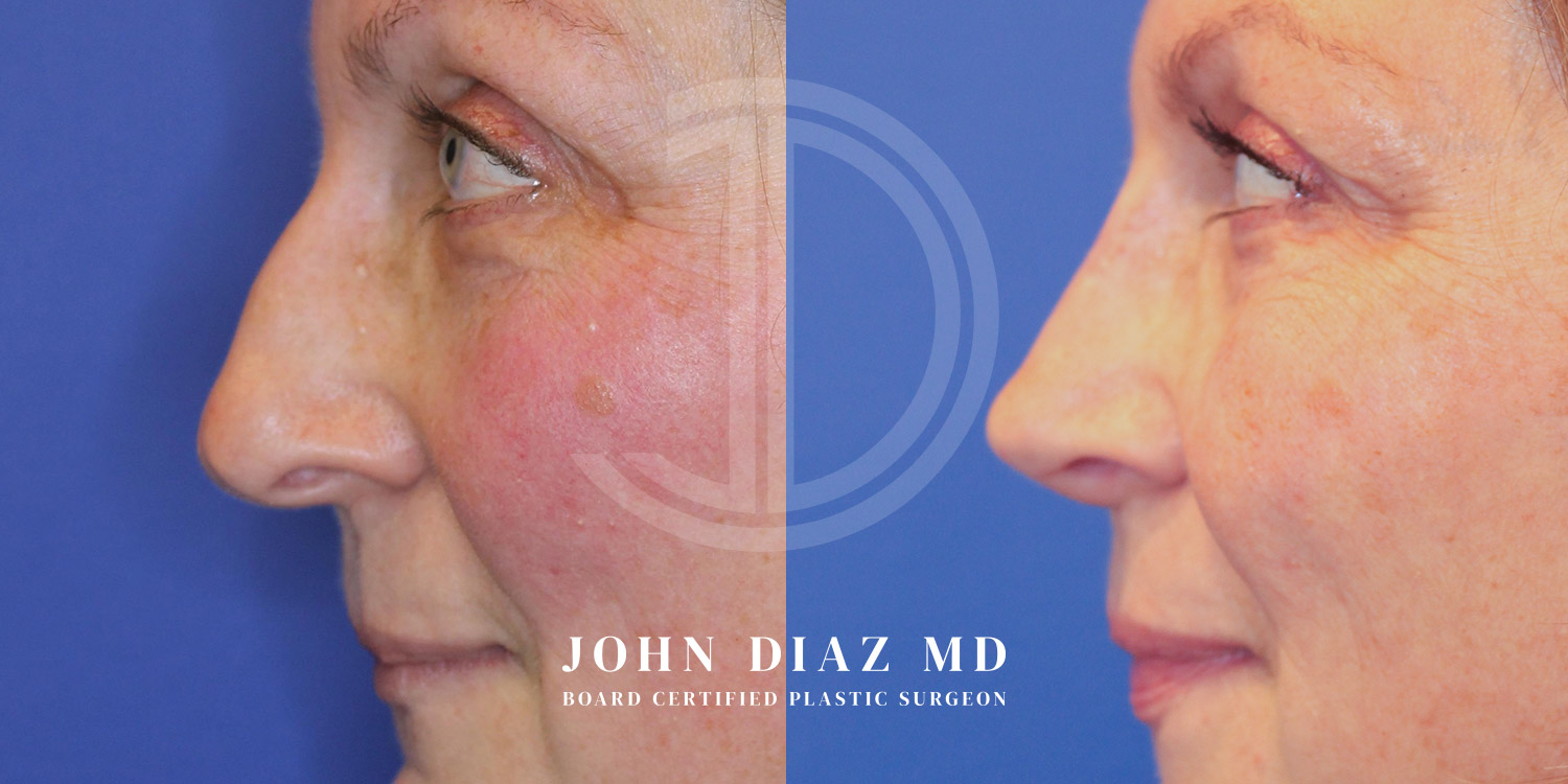 Dr John Diaz Before and After | Rhinoplasty