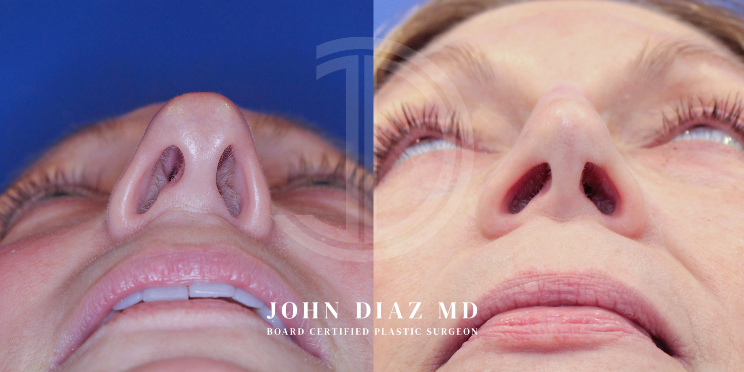 Dr John Diaz Before and After | Rhinoplasty