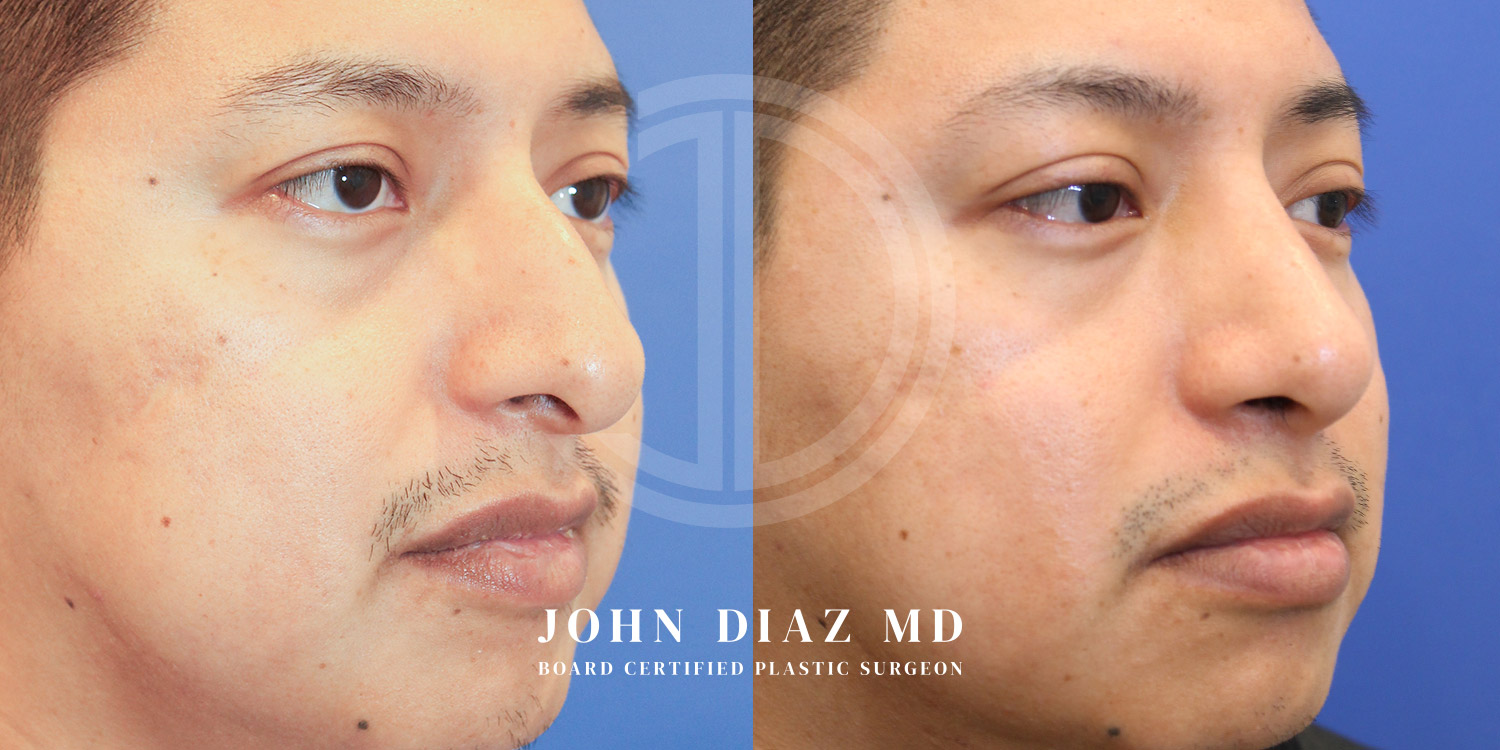 Dr John Diaz Before and After | Rhinoplasty