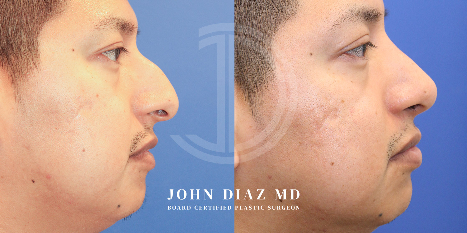 Dr John Diaz Before and After | Rhinoplasty