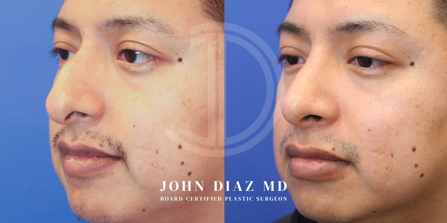 Dr John Diaz Before and After | Rhinoplasty