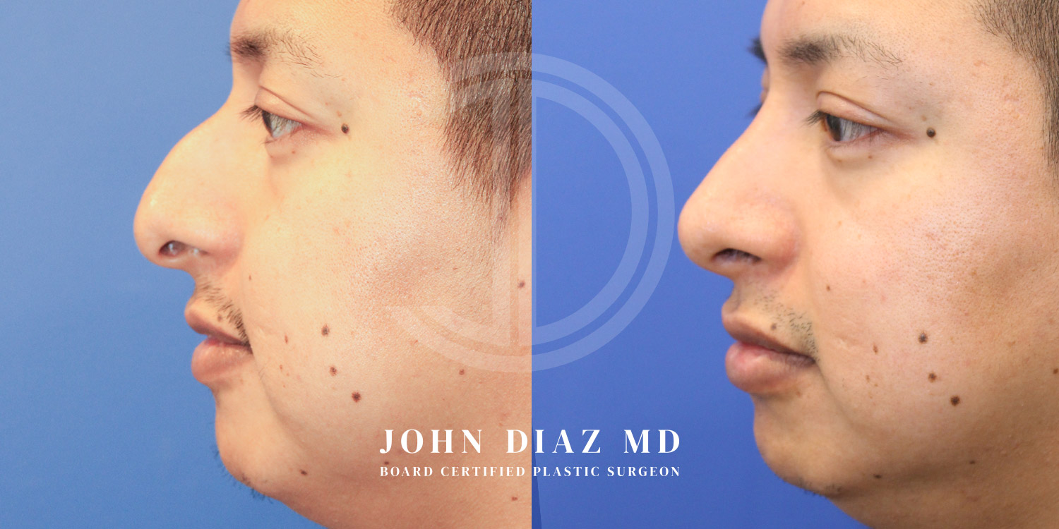 Dr John Diaz Before and After | Rhinoplasty