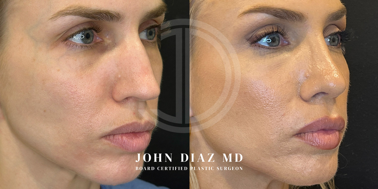 Dr John Diaz Before and After | Rhinoplasty