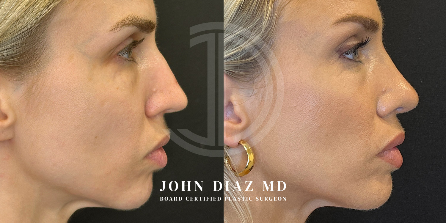 Dr John Diaz Before and After | Rhinoplasty