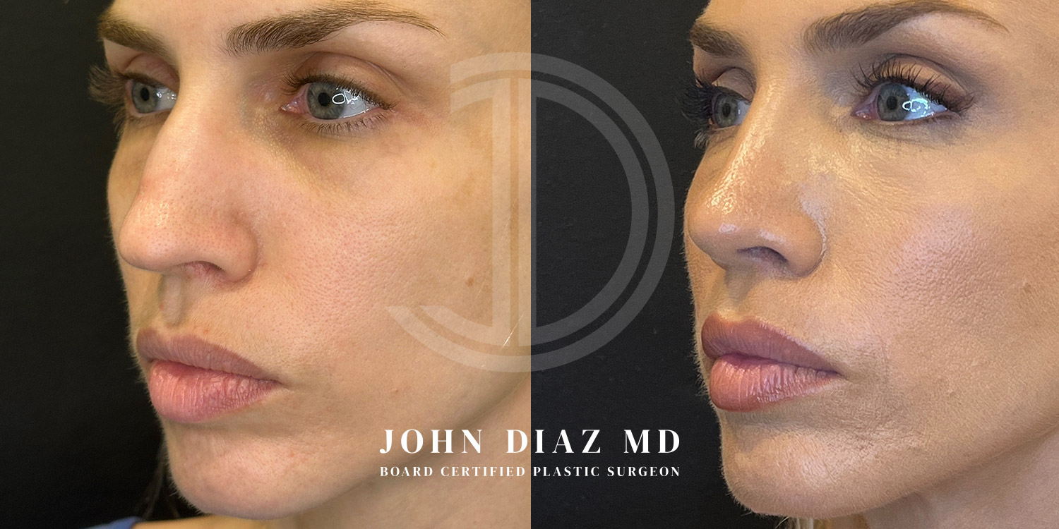 Dr John Diaz Before and After | Rhinoplasty
