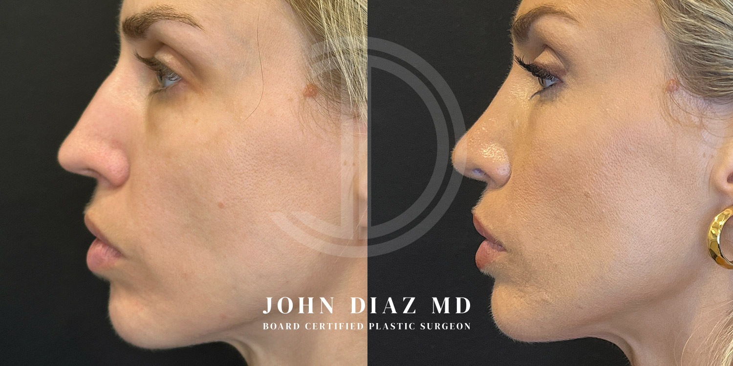 Dr John Diaz Before and After | Rhinoplasty