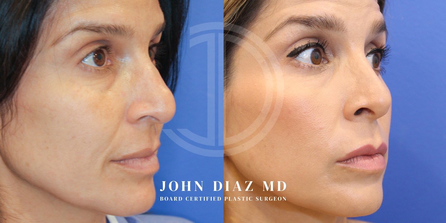 Dr John Diaz Before and After | Rhinoplasty