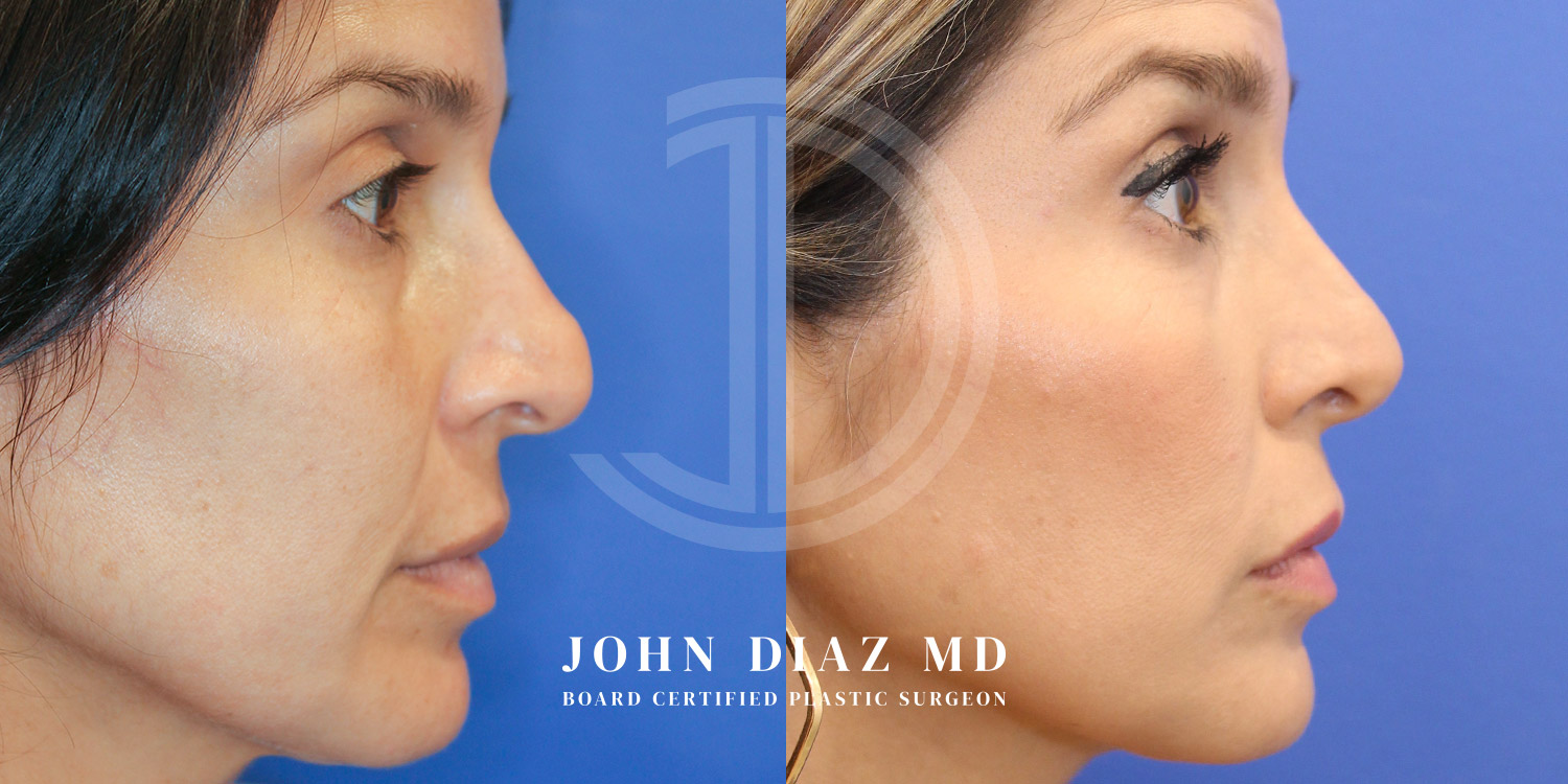 Dr John Diaz Before and After | Rhinoplasty