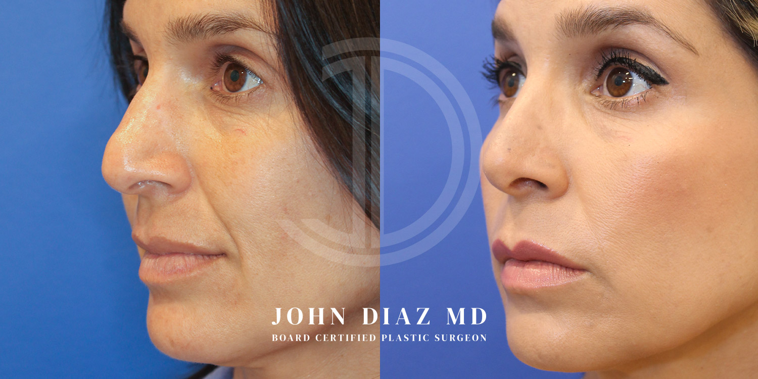 Dr John Diaz Before and After | Rhinoplasty