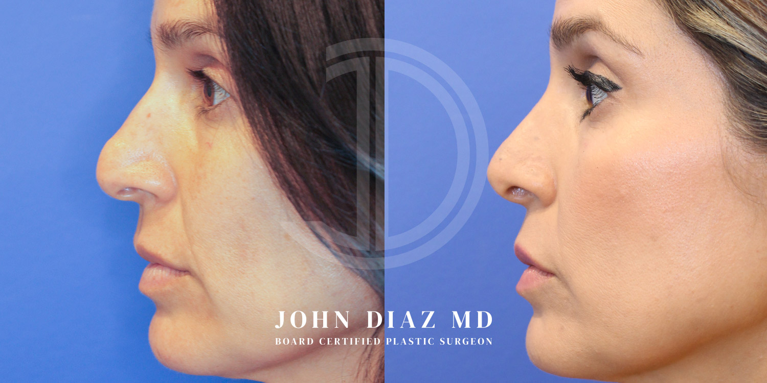 Dr John Diaz Before and After | Rhinoplasty