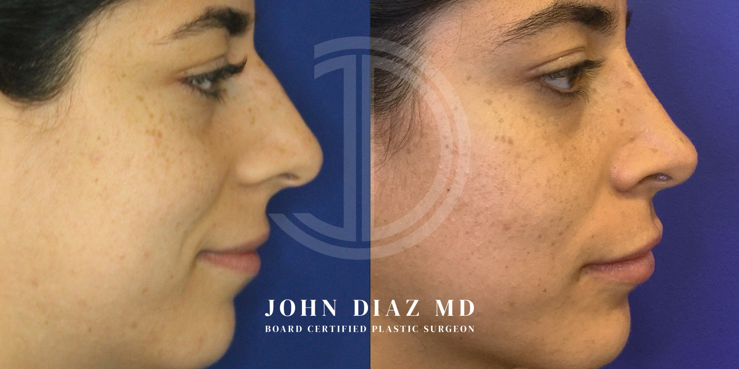 Dr John Diaz Before and After | Rhinoplasty