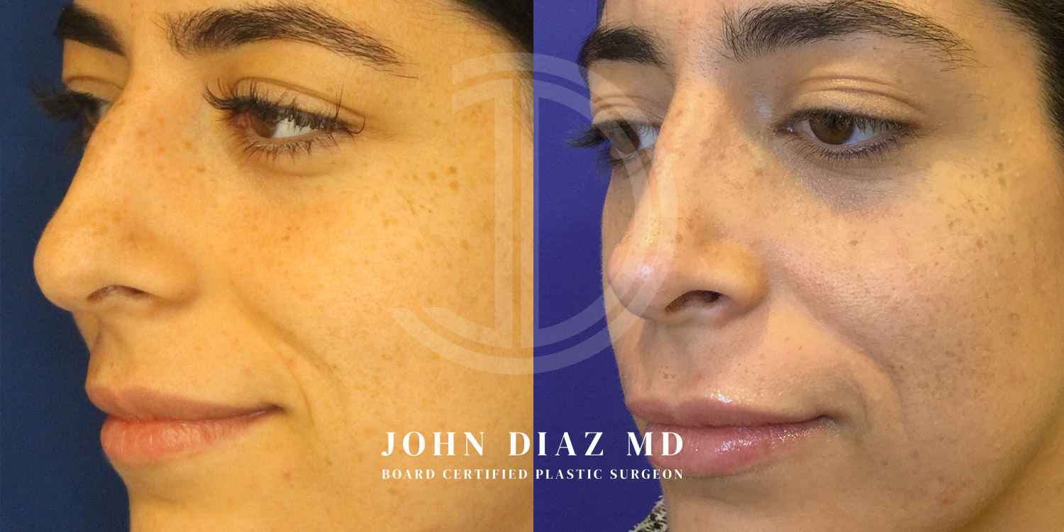 Dr John Diaz Before and After | Rhinoplasty