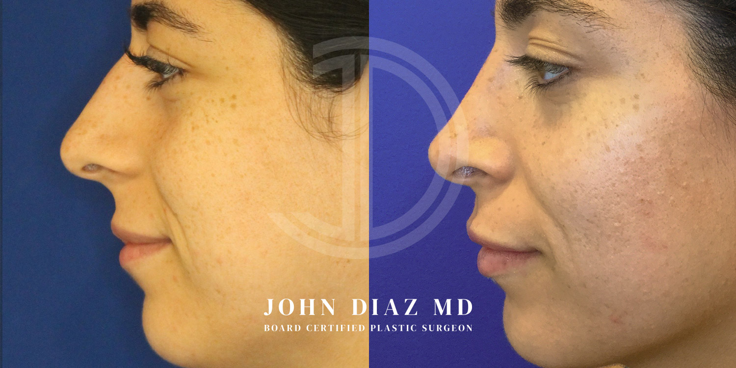 Dr John Diaz Before and After | Rhinoplasty
