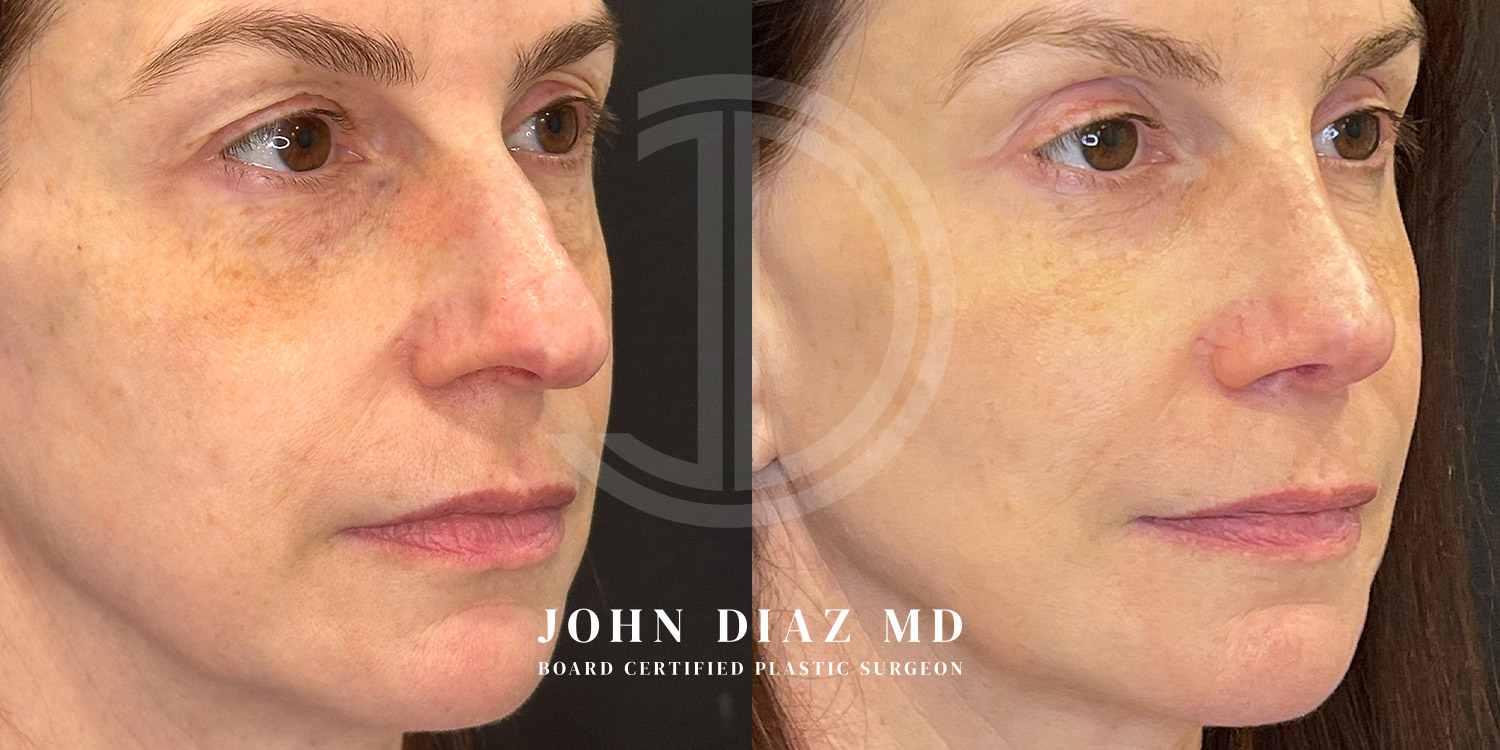 Dr John Diaz Before and After | Rhinoplasty