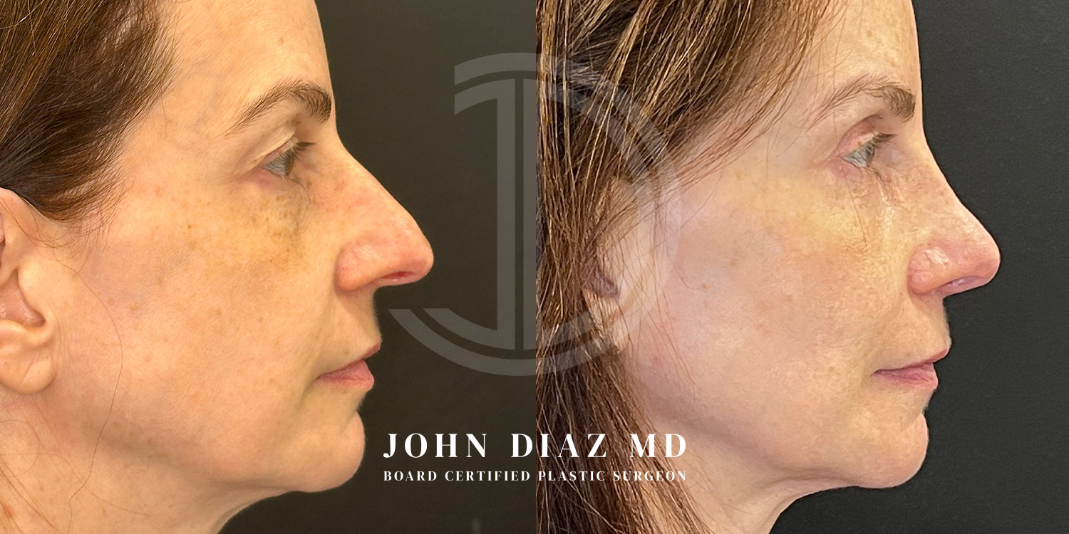 Dr John Diaz Before and After | Rhinoplasty