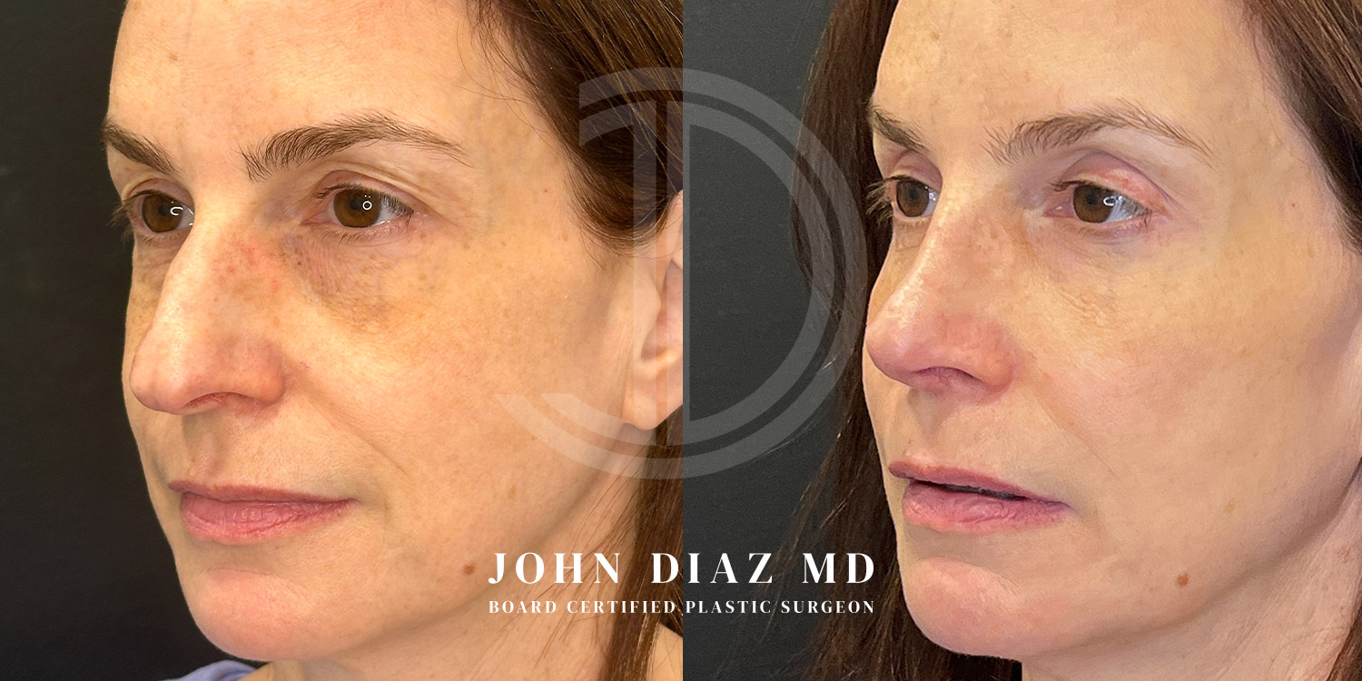 Dr John Diaz Before and After | Rhinoplasty