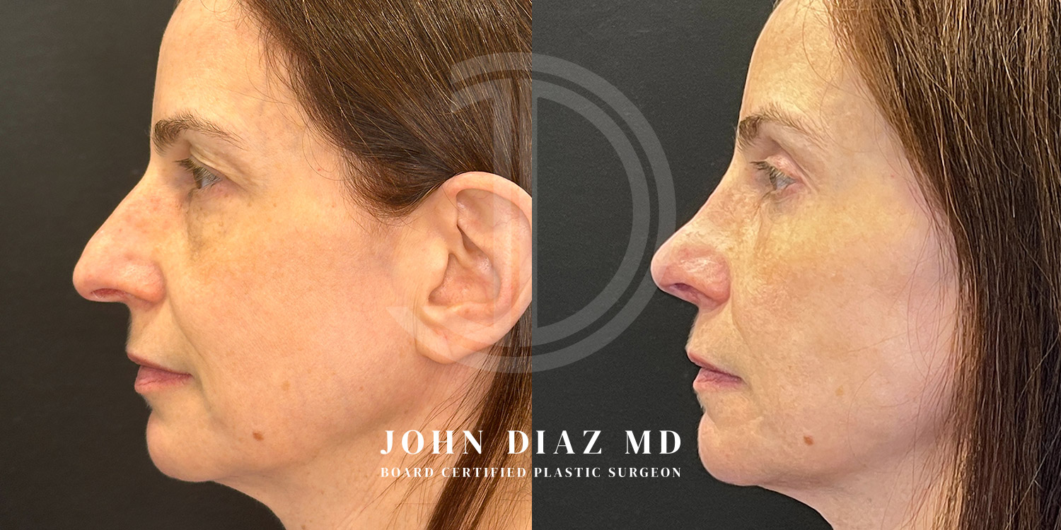 Dr John Diaz Before and After | Rhinoplasty