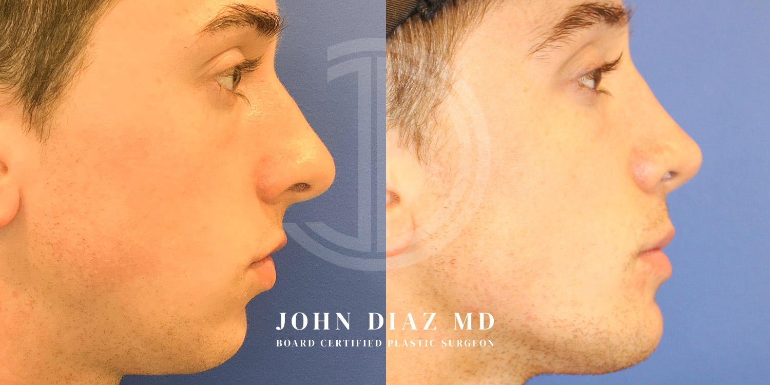 Dr John Diaz Before and After | Rhinoplasty