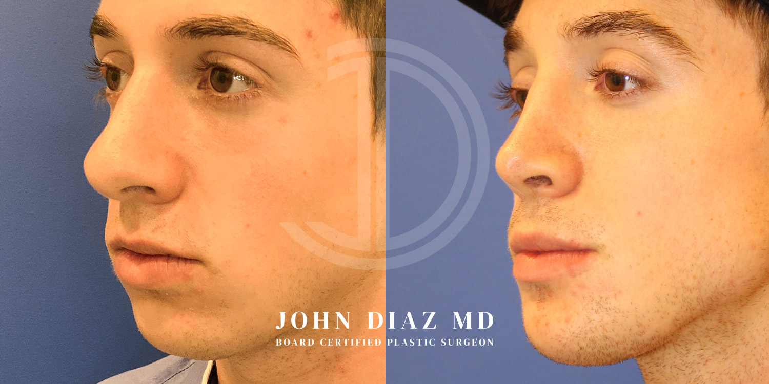 Dr John Diaz Before and After | Rhinoplasty
