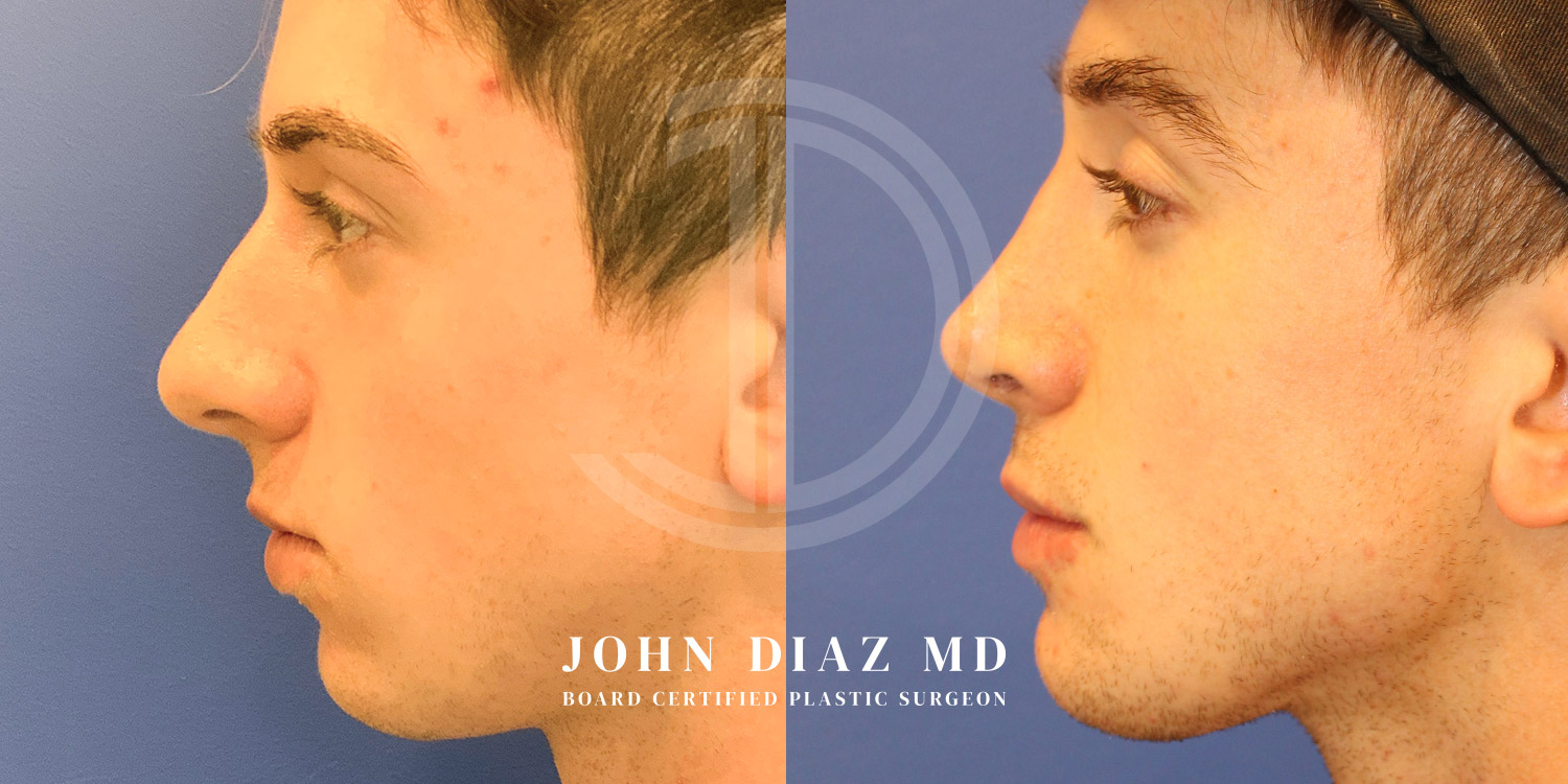 Dr John Diaz Before and After | Rhinoplasty