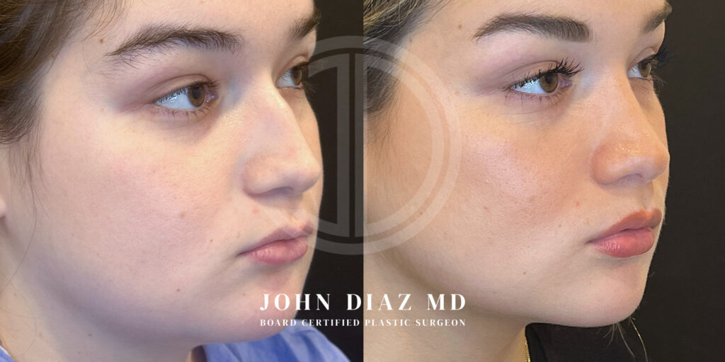 Dr John Diaz Before and After | Rhinoplasty