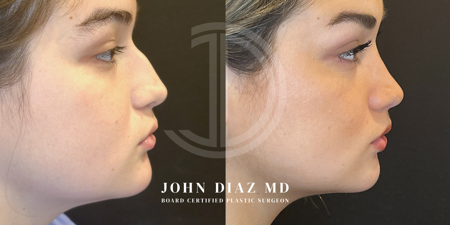 Dr John Diaz Before and After | Rhinoplasty