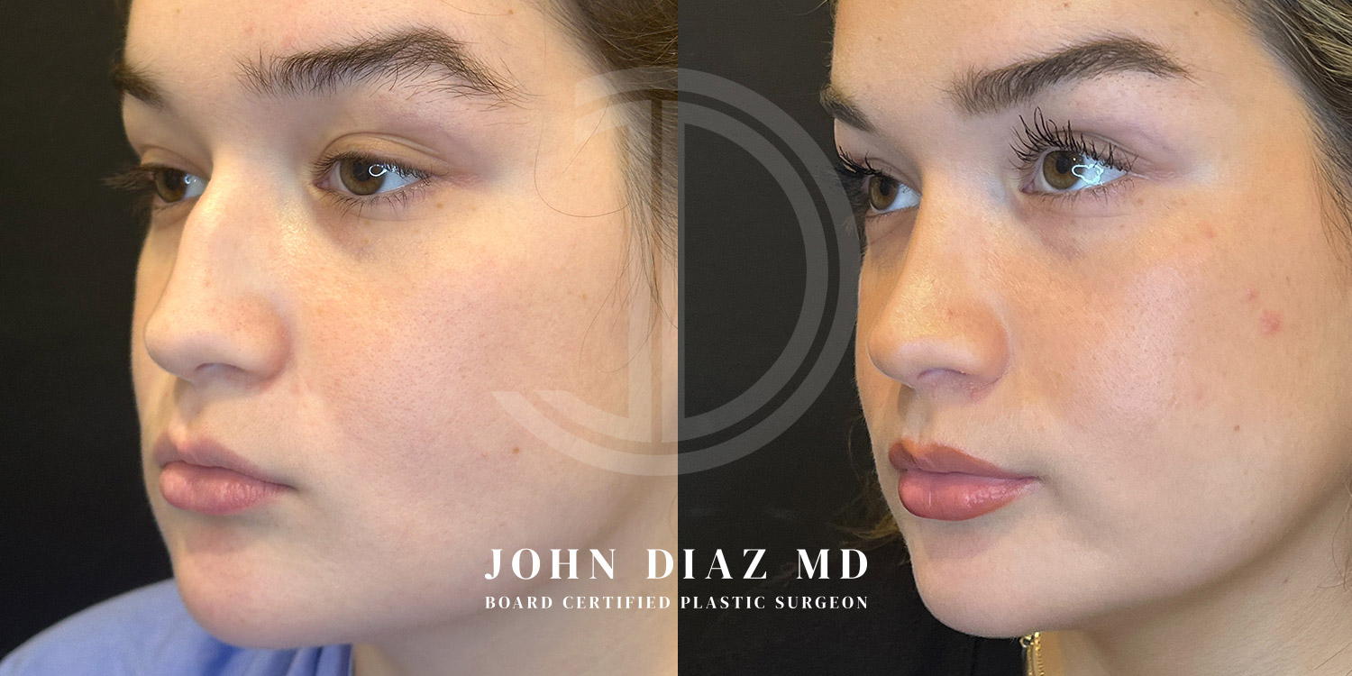 Dr John Diaz Before and After | Rhinoplasty