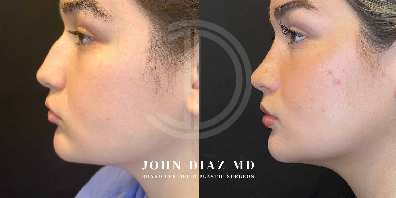 Dr John Diaz Before and After | Rhinoplasty