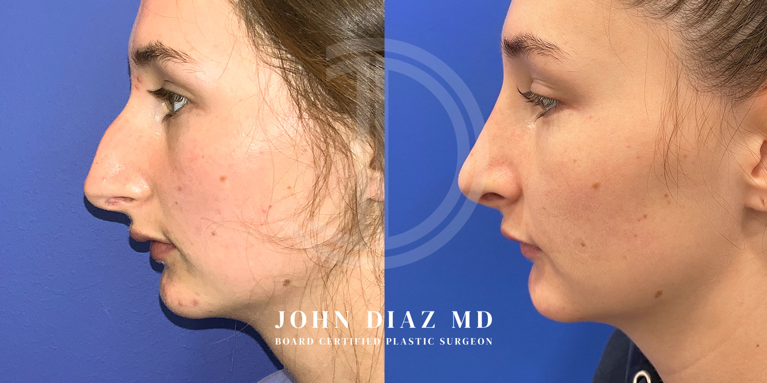 Dr John Diaz Before and After | Rhinoplasty