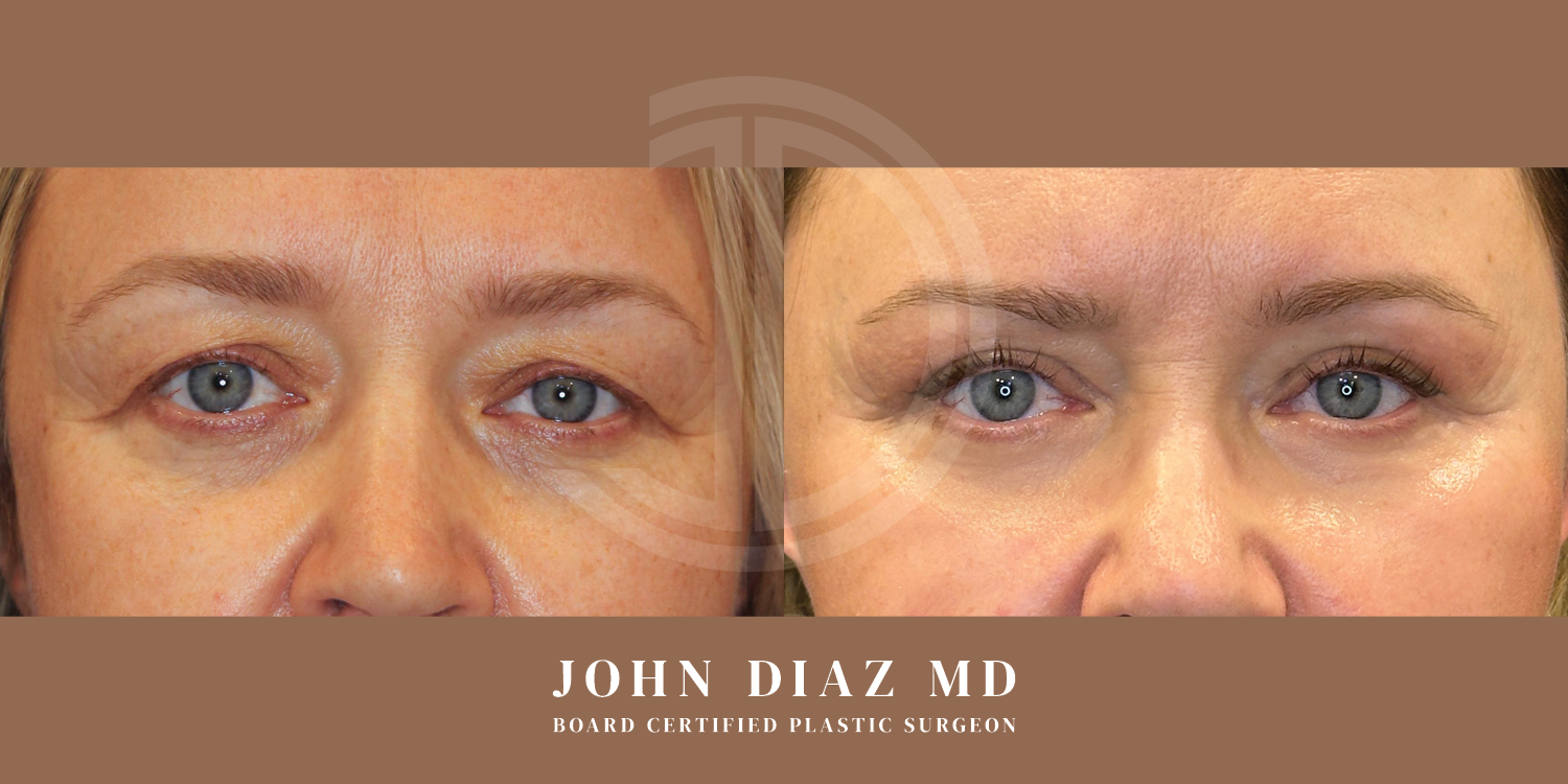 Dr John Diaz Before and After | Blepharoplasty