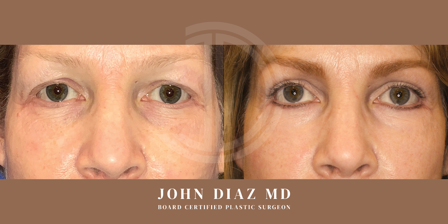 Dr John Diaz Before and After | Blepharoplasty