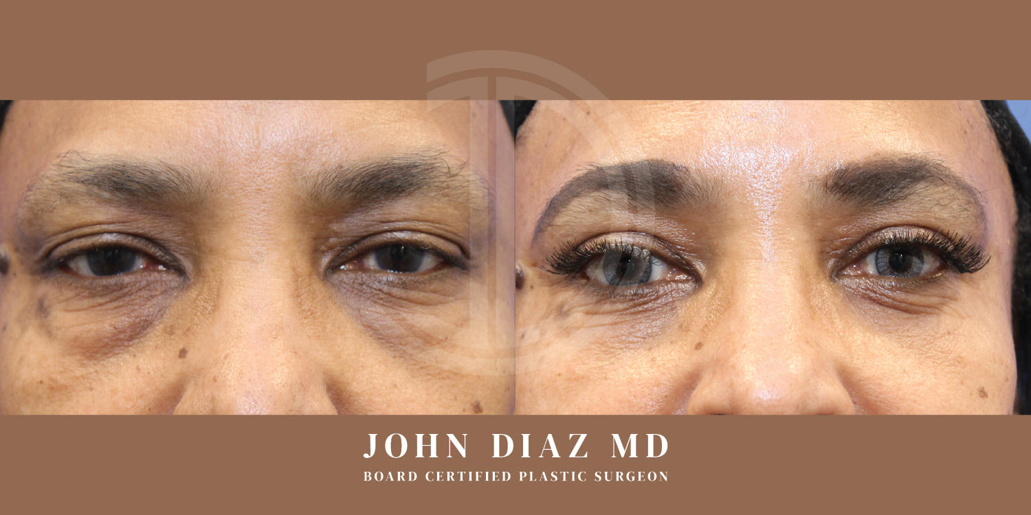 Dr John Diaz Before and After | Blepharoplasty