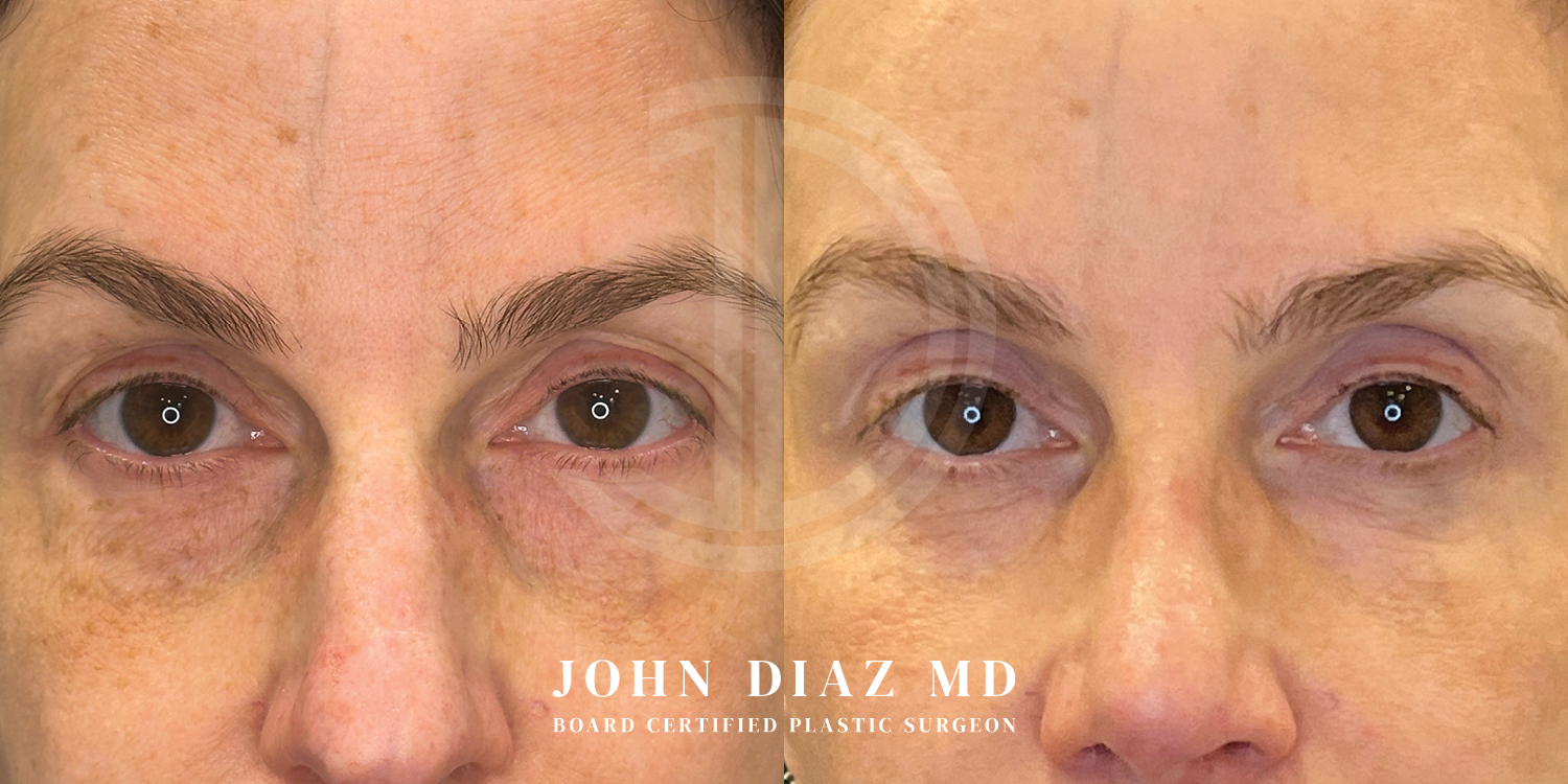 Dr John Diaz Before and After | Blepharoplasty