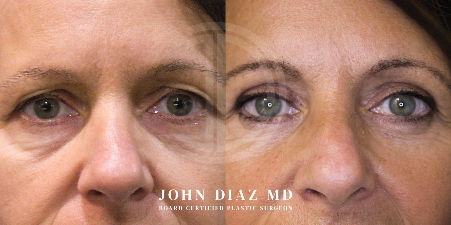 Dr John Diaz Before and After | Blepharoplasty