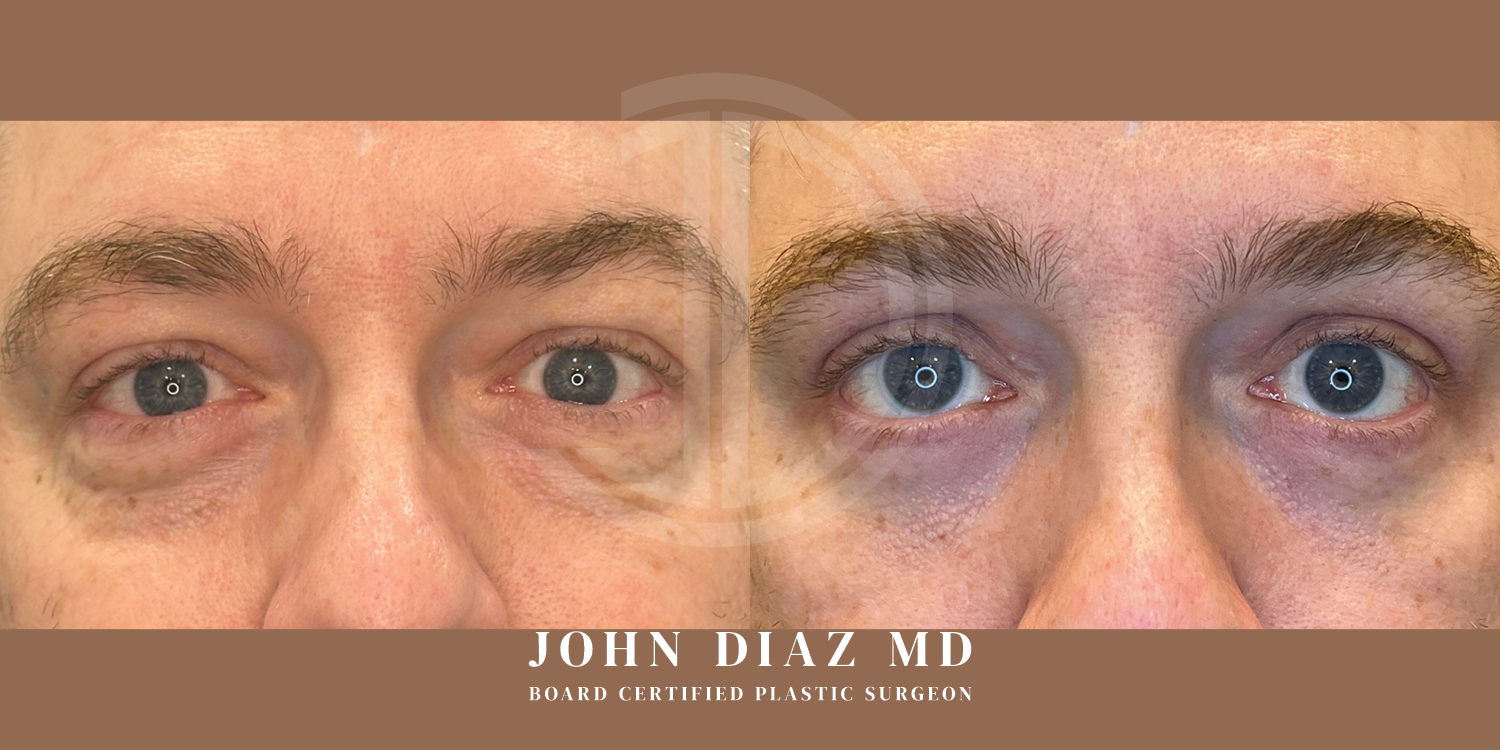 Dr John Diaz Before and After | Blepharoplasty