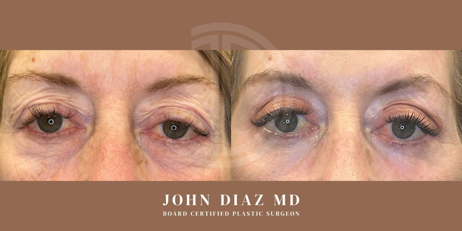 Dr John Diaz Before and After | Blepharoplasty