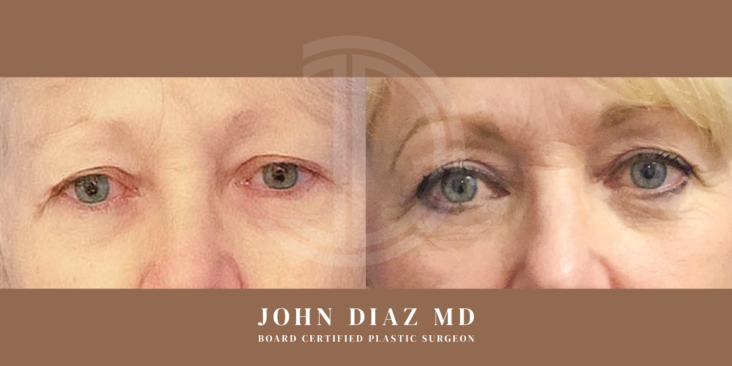 Dr John Diaz Before and After | Blepharoplasty