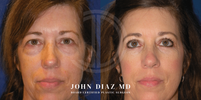 Dr John Diaz Before and After | Blepharoplasty