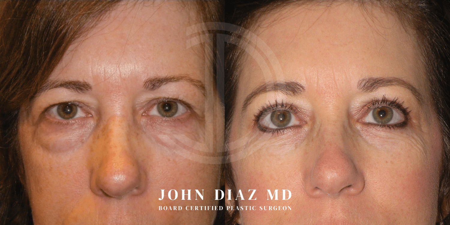 Dr John Diaz Before and After | Blepharoplasty