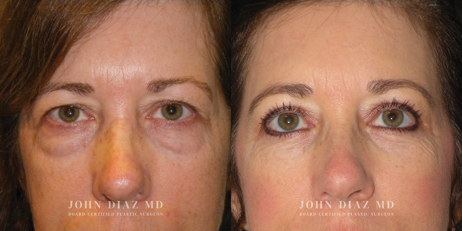 Dr John Diaz Before and After | Blepharoplasty
