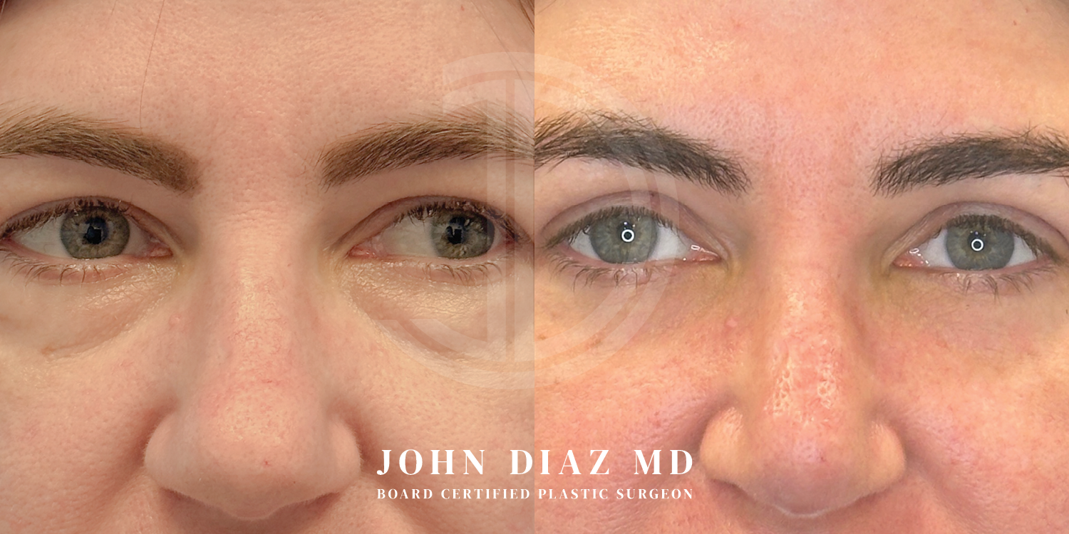 Dr John Diaz Before and After | Blepharoplasty