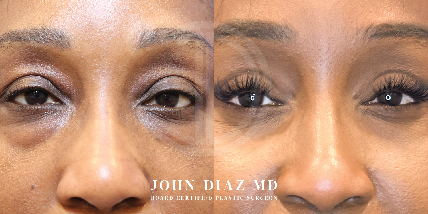 Dr John Diaz Before and After | Blepharoplasty