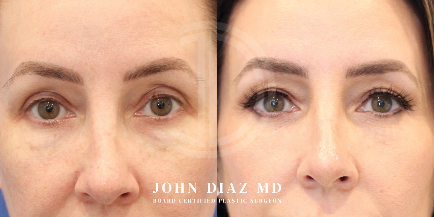 Dr John Diaz Before and After | Blepharoplasty